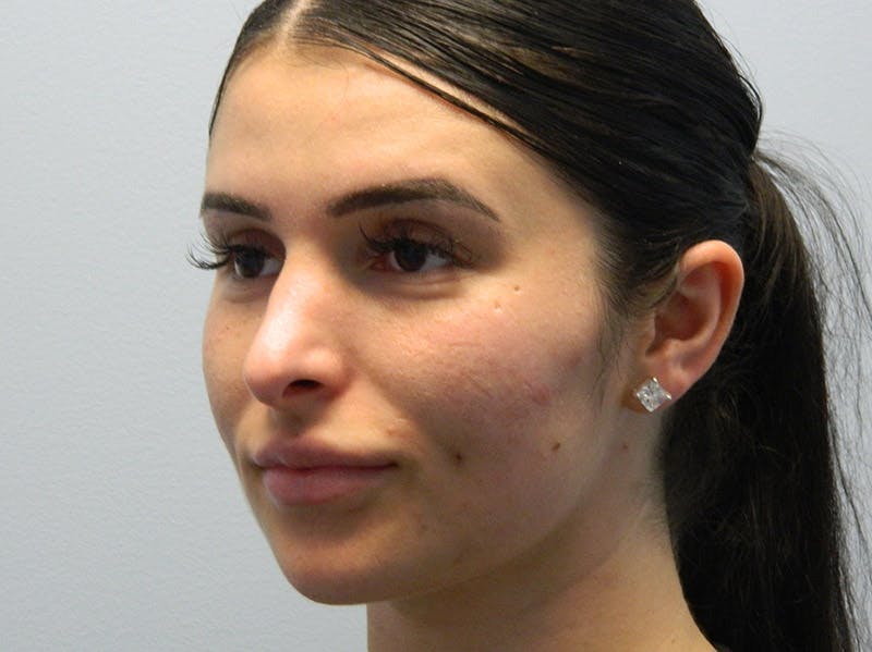 Rhinoplasty Before & After Gallery - Patient 133066313 - Image 7