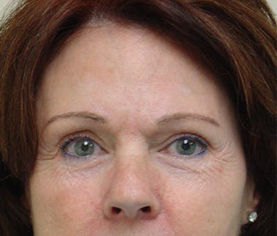 Brow Lift Before & After Gallery - Patient 133066310 - Image 1