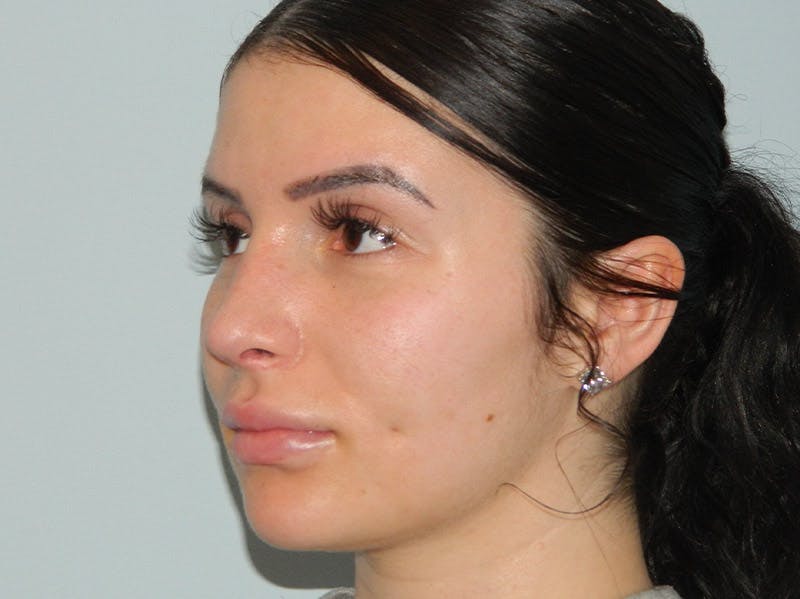Rhinoplasty Before & After Gallery - Patient 133066313 - Image 8