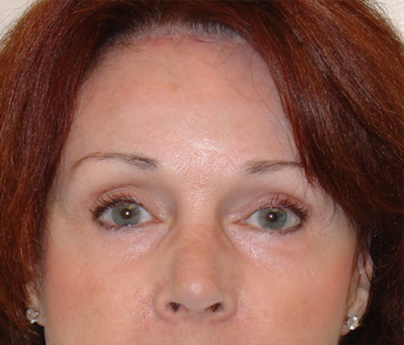 Brow Lift Before & After Gallery - Patient 133066310 - Image 2