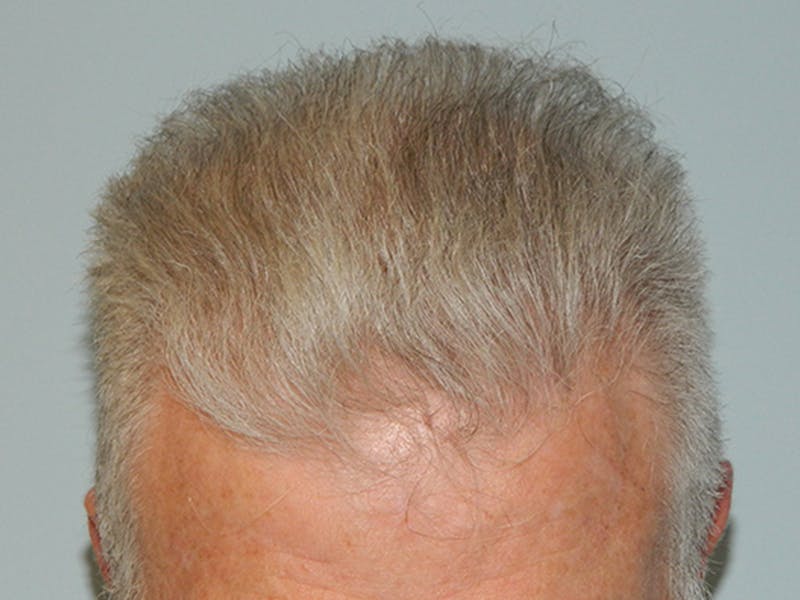 Hair Transplant (Smartgraft) Before & After Gallery - Patient 133066312 - Image 4