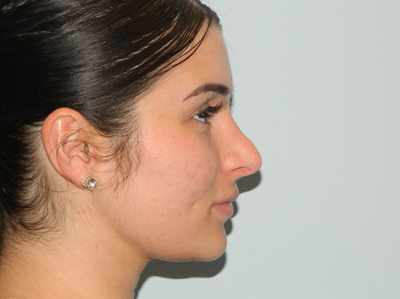 Rhinoplasty Before & After Gallery - Patient 133066313 - Image 9