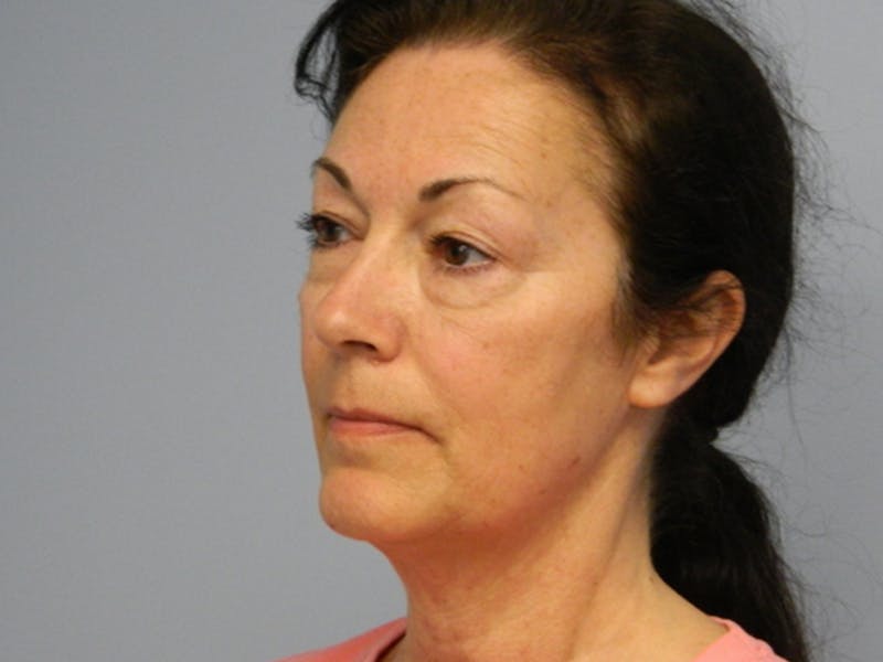 Mini-Facelift Before & After Gallery - Patient 133066319 - Image 1