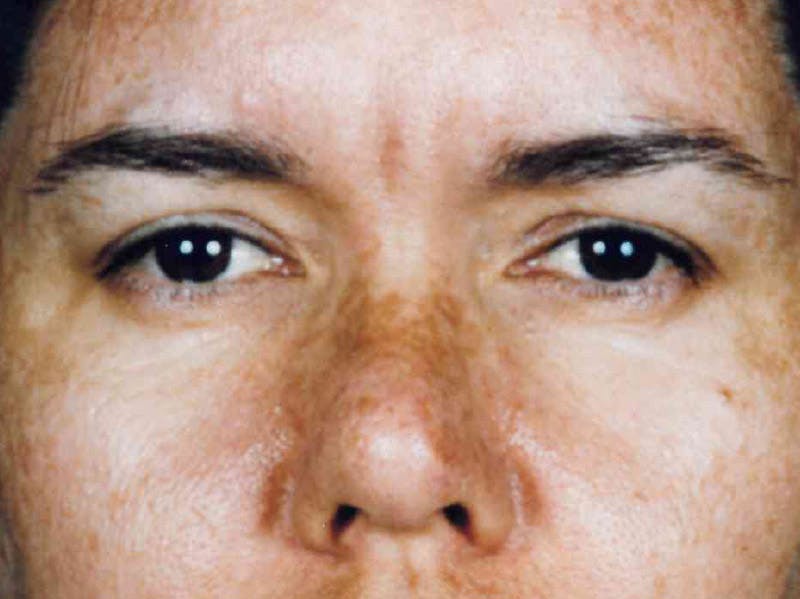Brow Lift Before & After Gallery - Patient 133066314 - Image 1