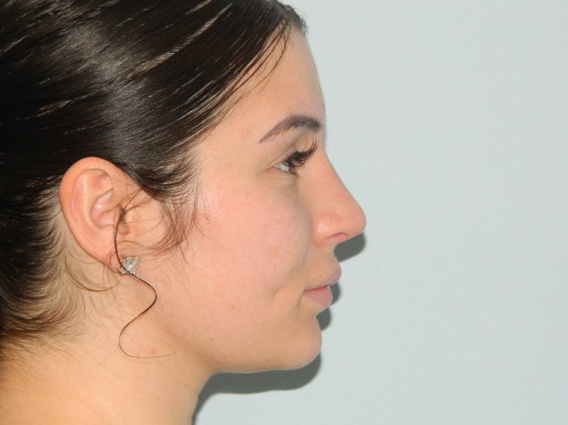 Rhinoplasty Before & After Gallery - Patient 133066313 - Image 10
