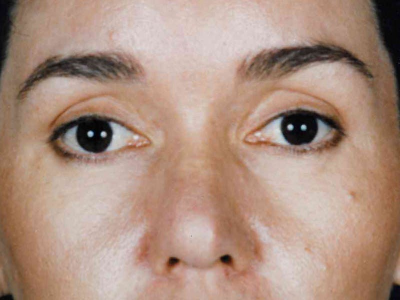 Brow Lift Before & After Gallery - Patient 133066314 - Image 2