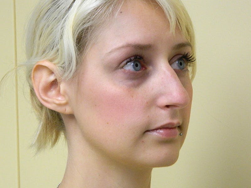 Rhinoplasty Before & After Gallery - Patient 133066321 - Image 1