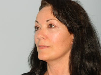 Mini-Facelift Before & After Gallery - Patient 133066319 - Image 2