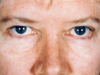 Brow Lift Before & After Gallery - Patient 133066316 - Image 1