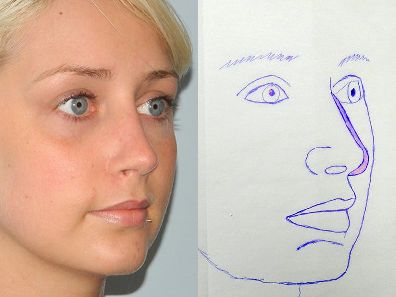 Rhinoplasty Before & After Gallery - Patient 133066321 - Image 2
