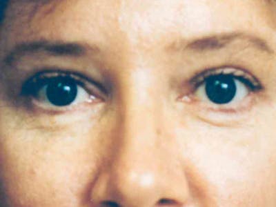 Brow Lift Before & After Gallery - Patient 133066316 - Image 2