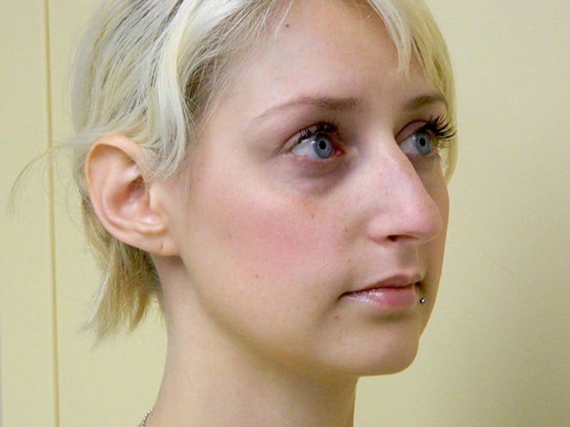 Rhinoplasty Before & After Gallery - Patient 133066321 - Image 3