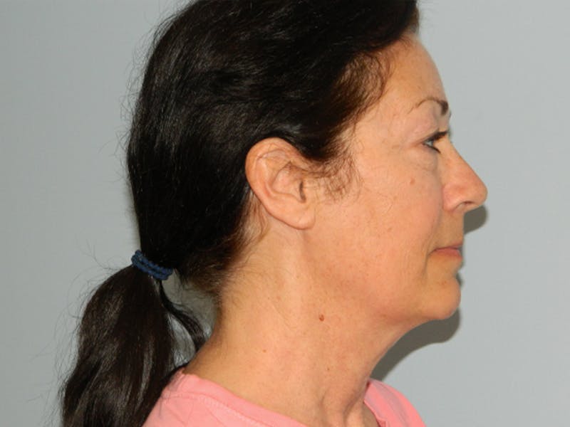 Mini-Facelift Before & After Gallery - Patient 133066319 - Image 3