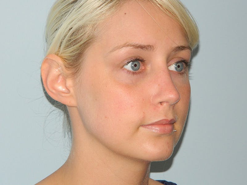 Before and After Rhinoplasty in Philadelphia