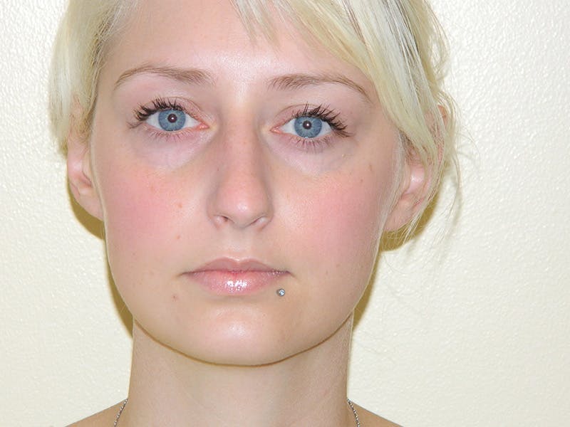 Rhinoplasty Before & After Gallery - Patient 133066321 - Image 5