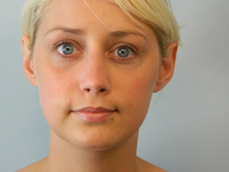 Rhinoplasty Before & After Gallery - Patient 133066321 - Image 6