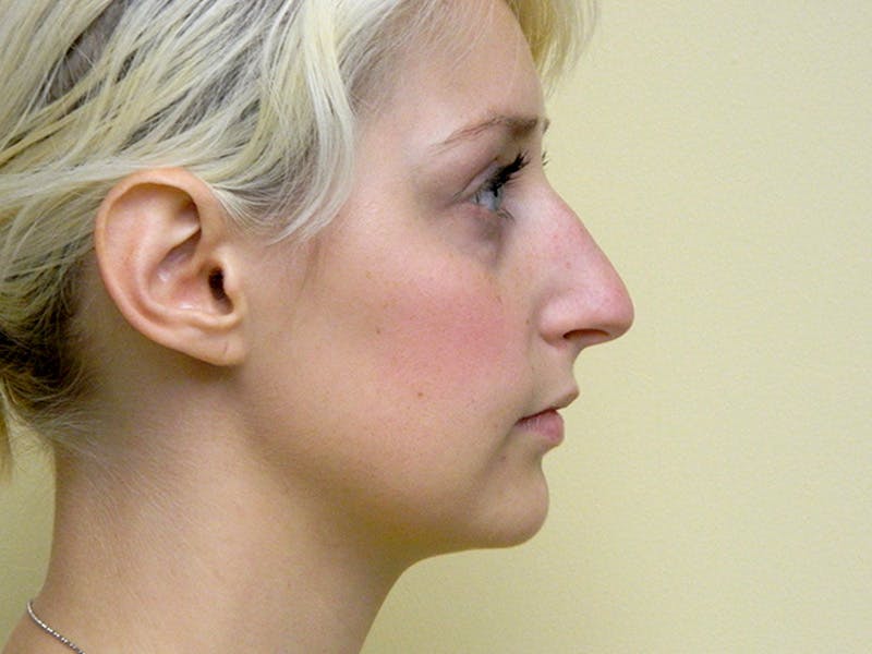 Rhinoplasty Before & After Gallery - Patient 133066321 - Image 7