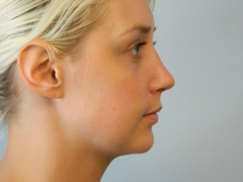Rhinoplasty Before & After Gallery - Patient 133066321 - Image 8