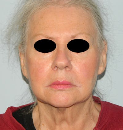 Mini-Facelift Before & After Gallery - Patient 133066332 - Image 1