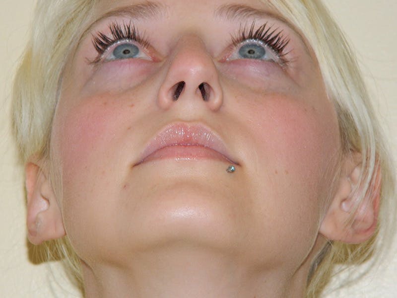 Rhinoplasty Before & After Gallery - Patient 133066321 - Image 9