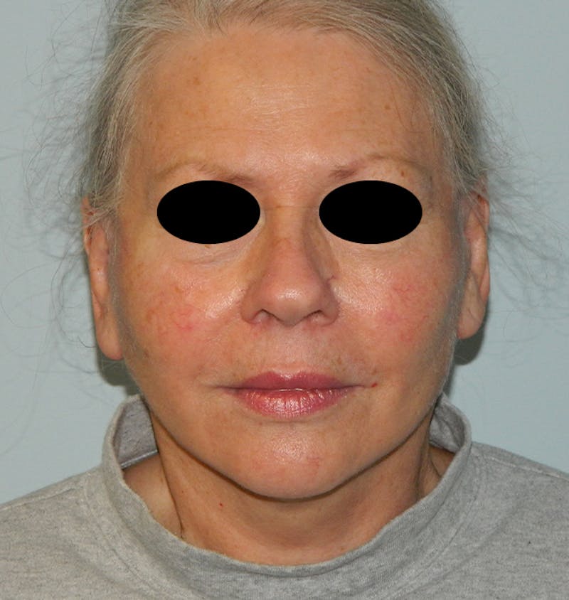 Mini-Facelift Before & After Gallery - Patient 133066332 - Image 2
