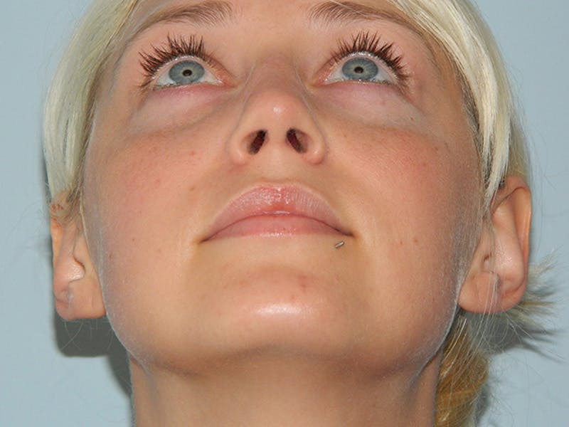 Rhinoplasty Before & After Gallery - Patient 133066321 - Image 10