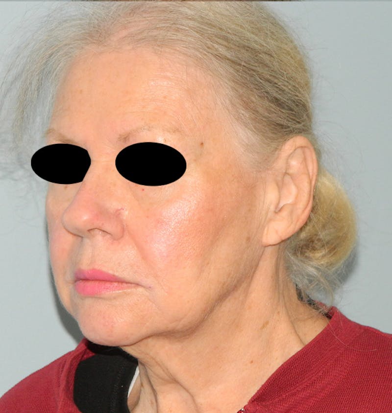 Mini-Facelift Before & After Gallery - Patient 133066332 - Image 3