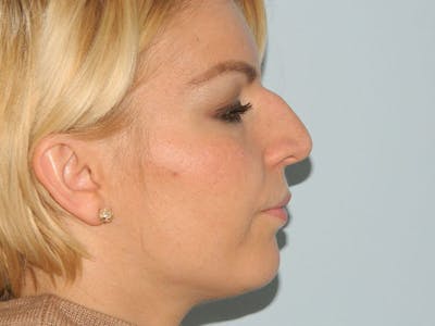 Rhinoplasty Before & After Gallery - Patient 133066372 - Image 1