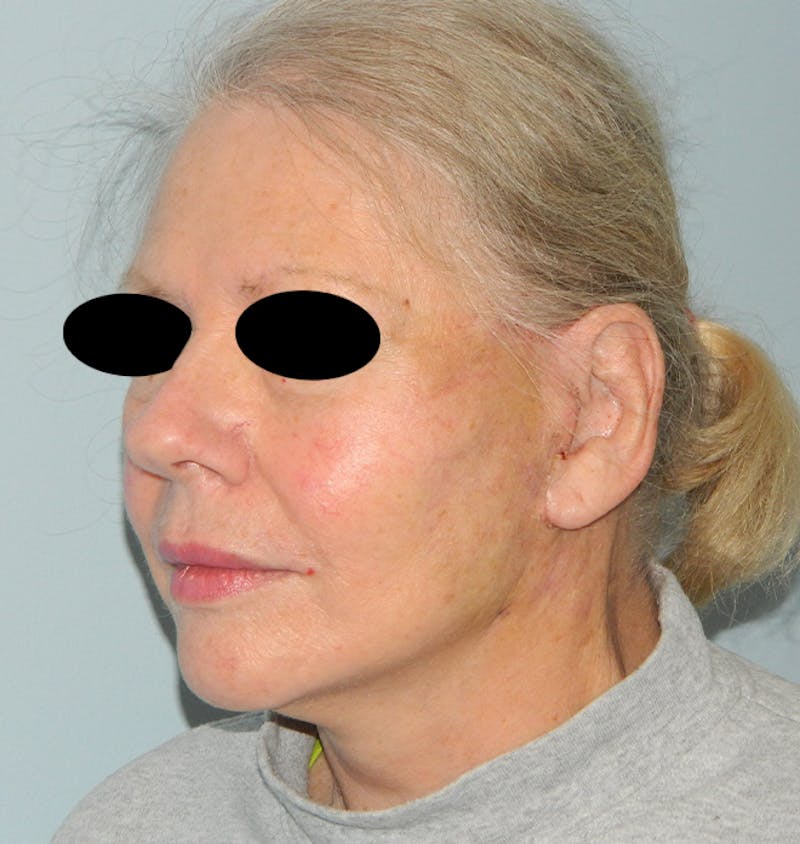 Mini-Facelift Before & After Gallery - Patient 133066332 - Image 4