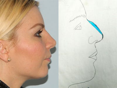 Rhinoplasty Before & After Gallery - Patient 133066372 - Image 2
