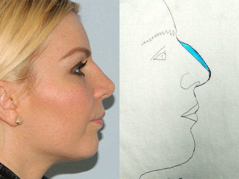 Rhinoplasty Before & After Gallery - Patient 133066372 - Image 2