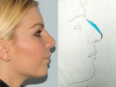 Rhinoplasty Before & After Gallery - Patient 133066372 - Image 2