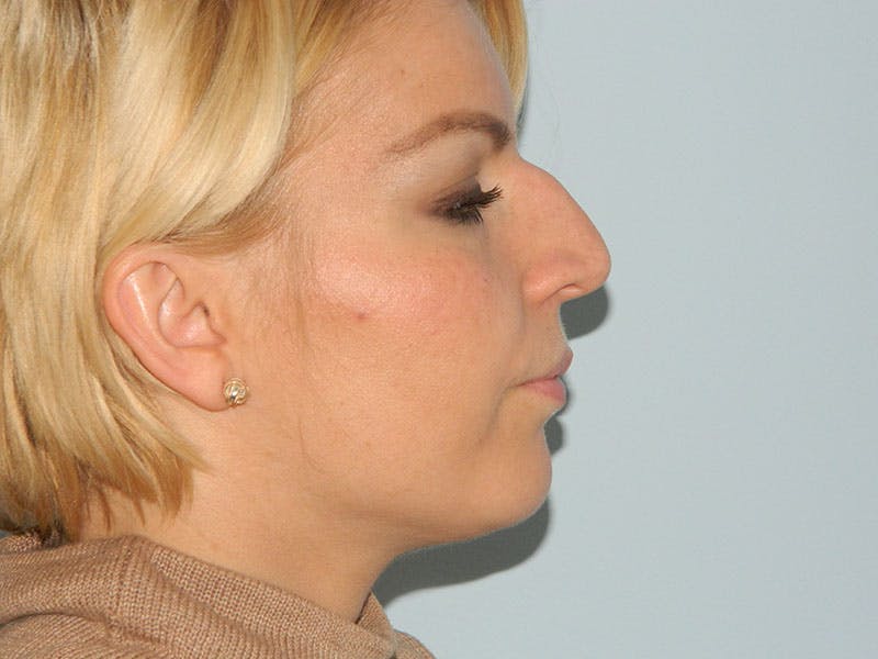 Rhinoplasty Before & After Gallery - Patient 133066372 - Image 3