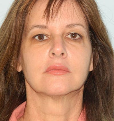 Mini-Facelift Before & After Gallery - Patient 133066369 - Image 1