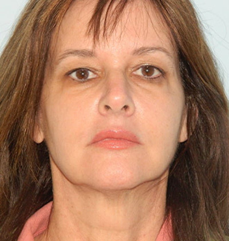 Mini-Facelift Before & After Gallery - Patient 133066369 - Image 1