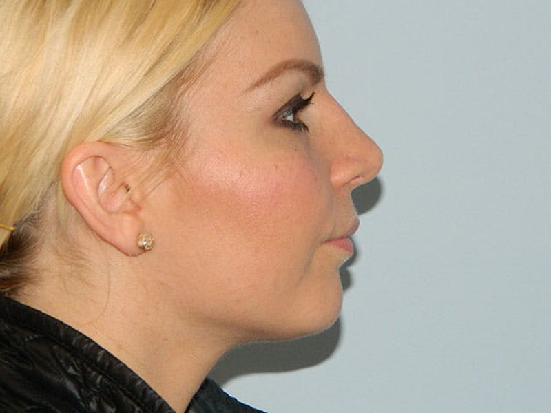 Rhinoplasty Before & After Gallery - Patient 133066372 - Image 4