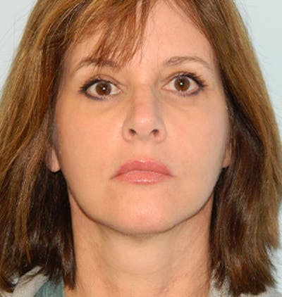 Mini-Facelift Before & After Gallery - Patient 133066369 - Image 2