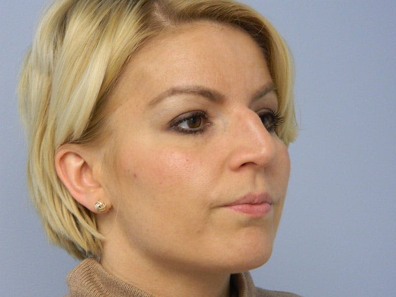 Rhinoplasty Before & After Gallery - Patient 133066372 - Image 5