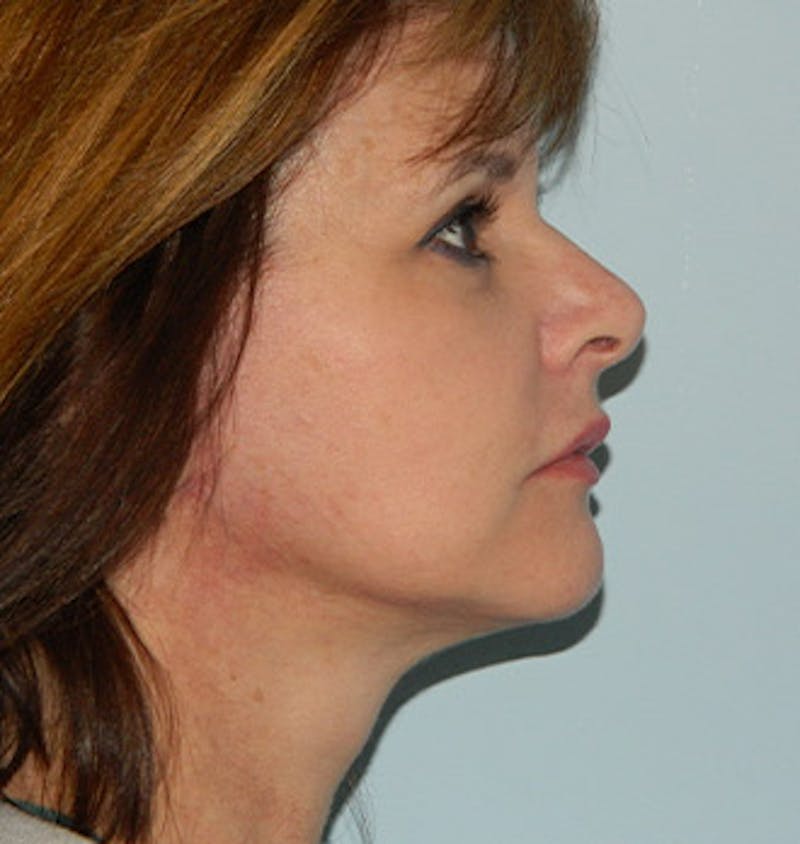 Mini-Facelift Before & After Gallery - Patient 133066369 - Image 4