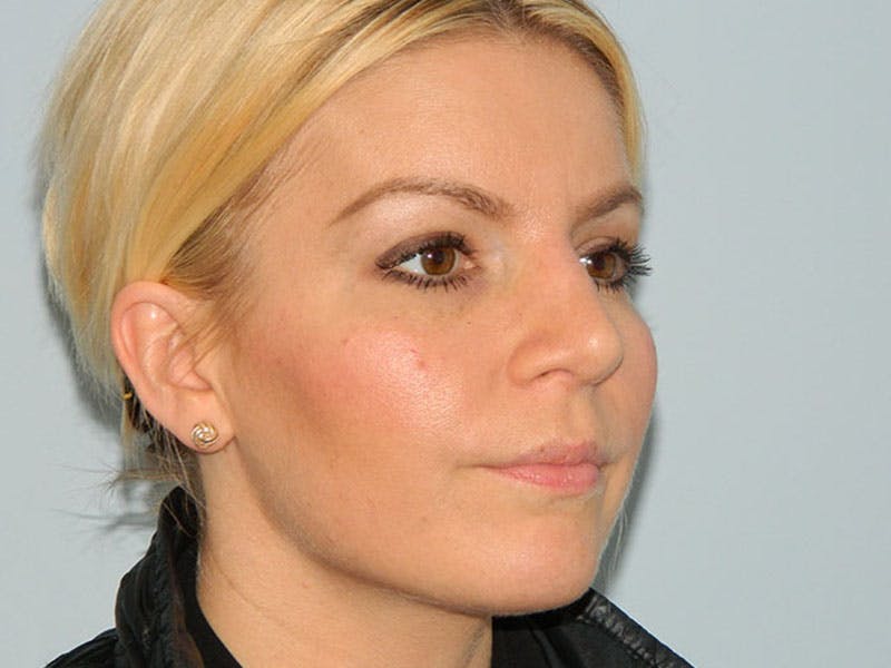 Rhinoplasty Before & After Gallery - Patient 133066372 - Image 6