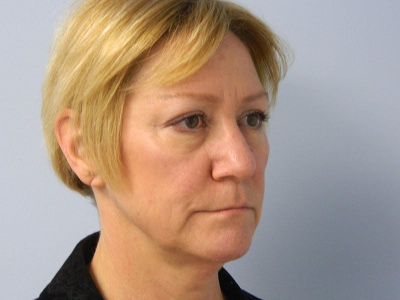 Brow Lift Before & After Gallery - Patient 133066371 - Image 3