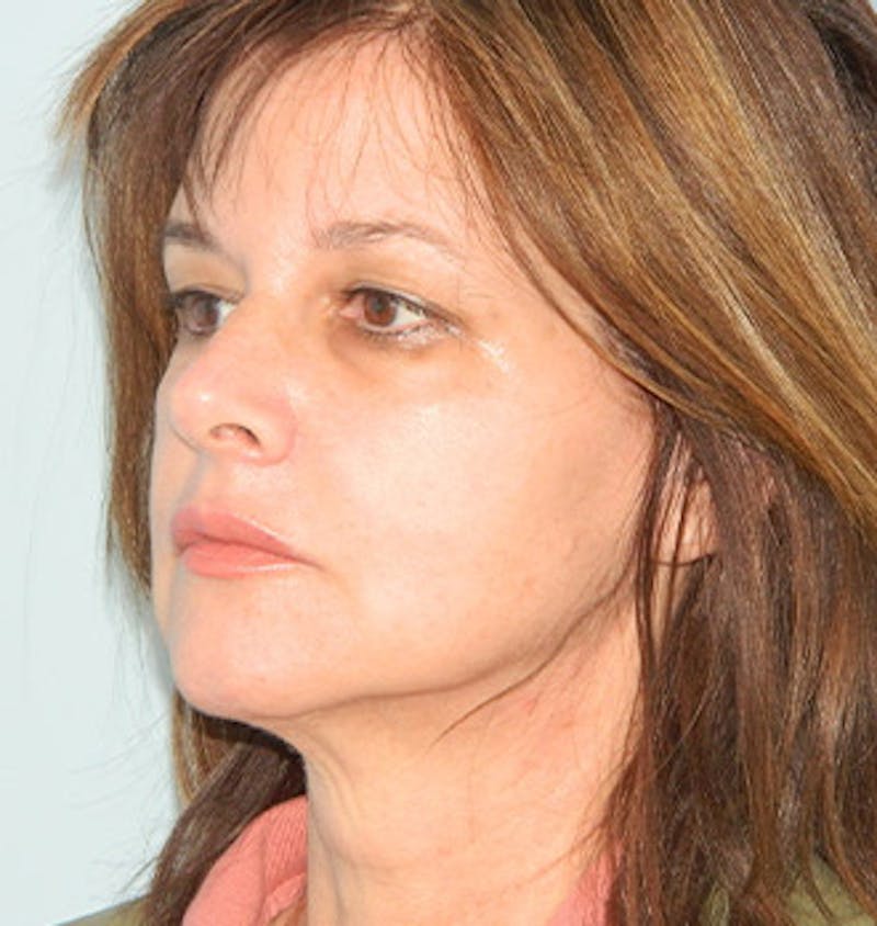 Mini-Facelift Before & After Gallery - Patient 133066369 - Image 5