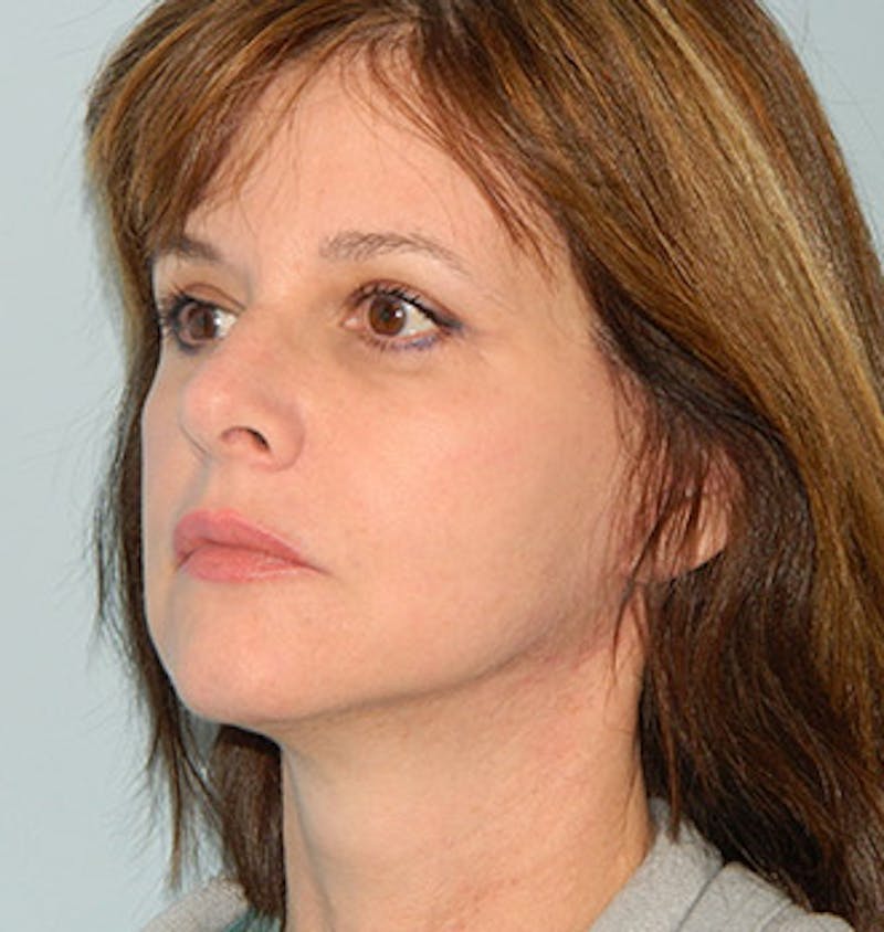 Mini-Facelift Before & After Gallery - Patient 133066369 - Image 6