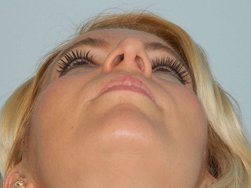 Rhinoplasty Before & After Gallery - Patient 133066372 - Image 9