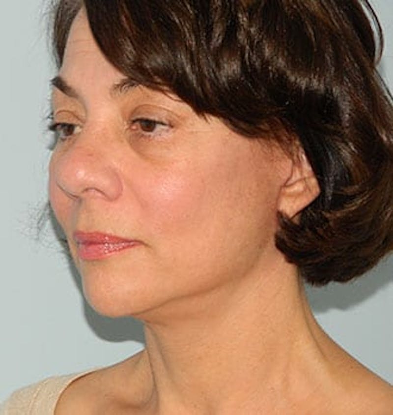 Mini-Facelift Before & After Gallery - Patient 133066373 - Image 2