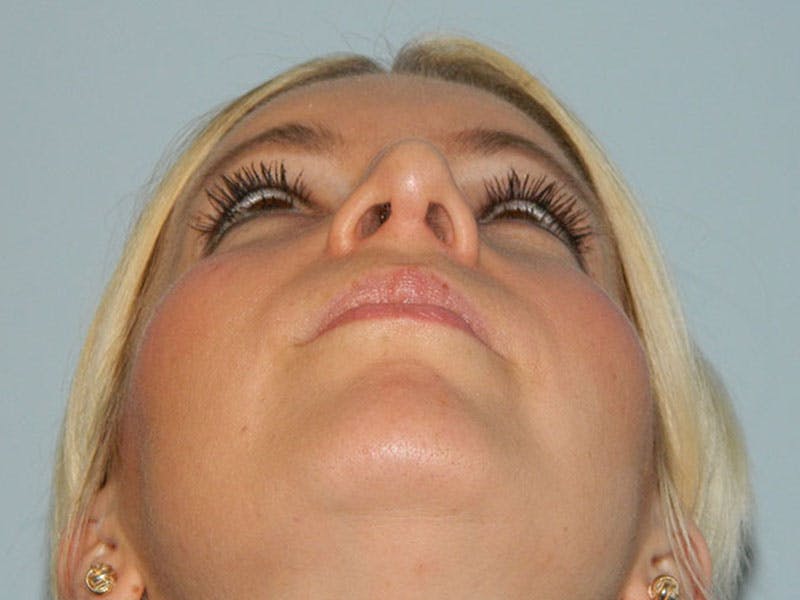 Rhinoplasty Before & After Gallery - Patient 133066372 - Image 10
