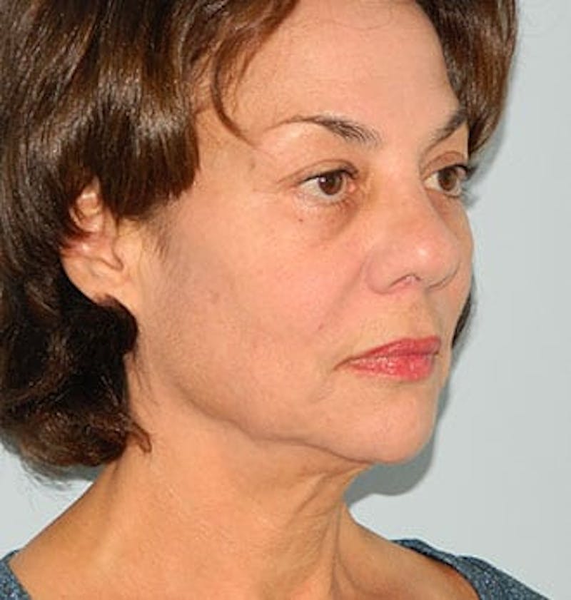 Mini-Facelift Before & After Gallery - Patient 133066373 - Image 3