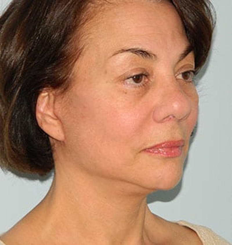 Mini-Facelift Before & After Gallery - Patient 133066373 - Image 4