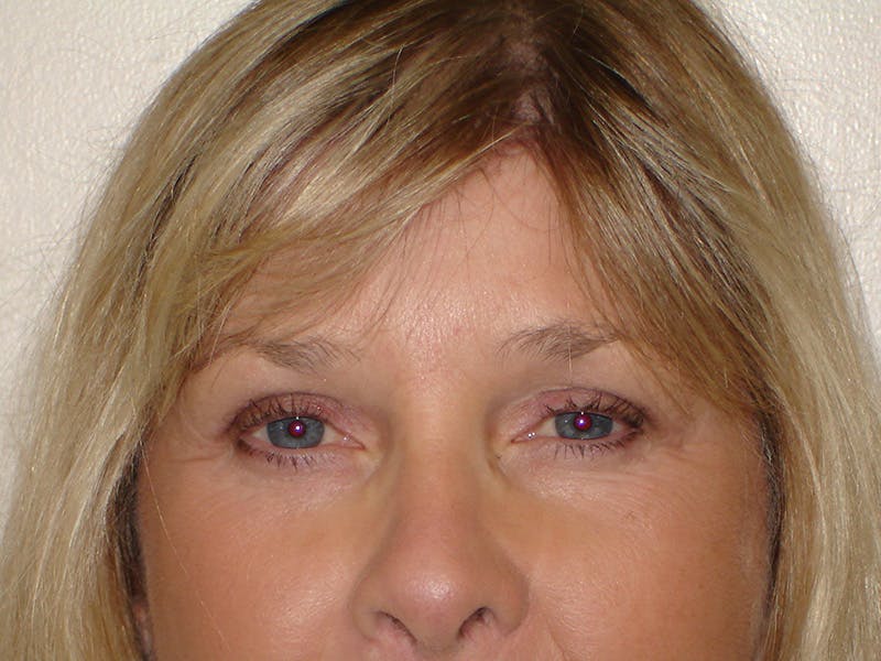 Brow Lift Before & After Gallery - Patient 133066374 - Image 2