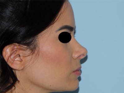 Rhinoplasty Before & After Gallery - Patient 133066378 - Image 1